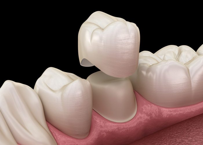 Implant dentaire Arras