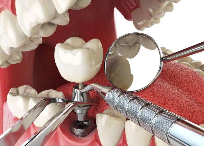 création d'implant dentaire sur mesure via pivot à Arras